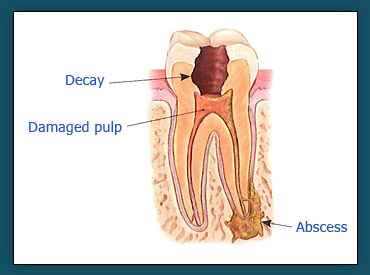 Root Canals (Step 1)