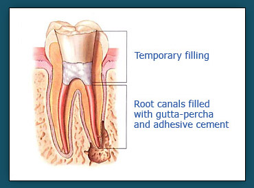 Root Canals (Step 3)