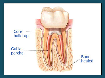 Root Canals (Step 4a)