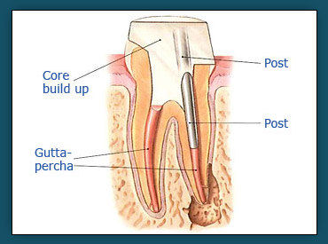 Root Canals (Step 4b)